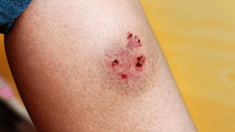 Close-up of a human leg showing a fresh, red dog bite wound with multiple punctures
