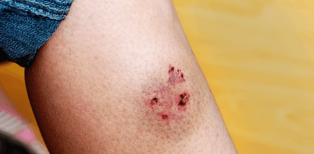 Common Injuries from Dog Bite Attacks